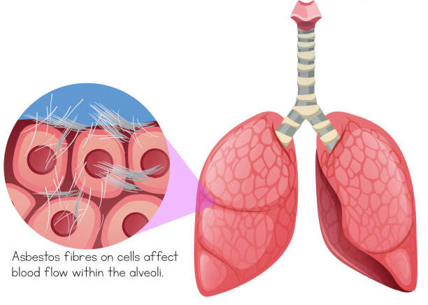 Asbestos Effects